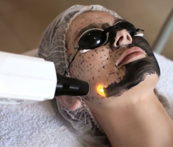 Carbon Laser at Dr Sree Healthcare