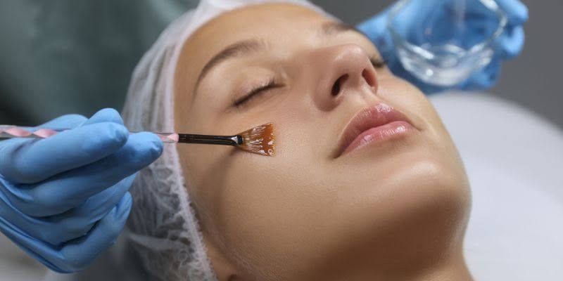 Chemical Peel at Dr Sree Healthcare