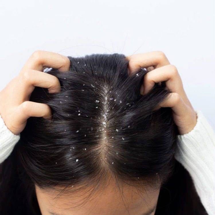 Dandruff Treatment at Dr Sree Healthcare