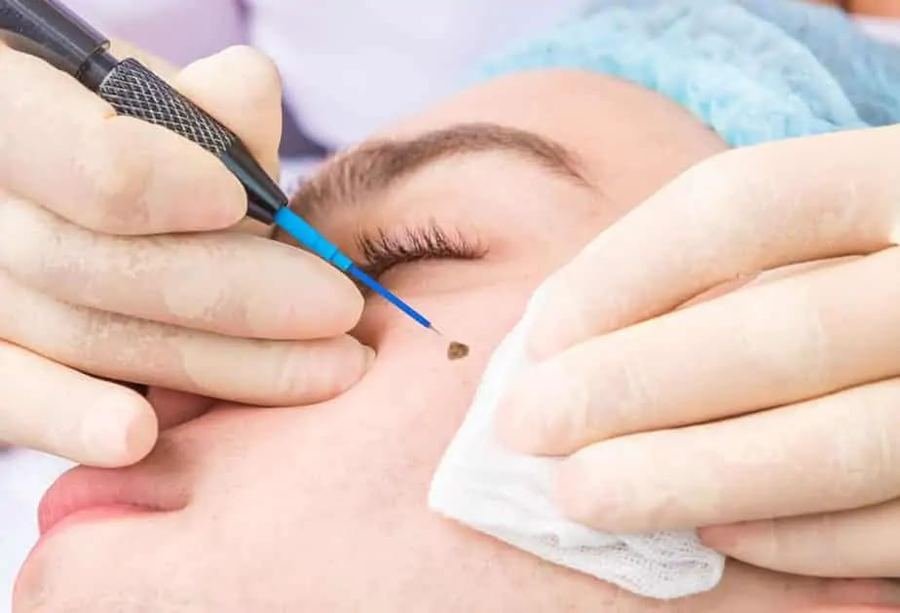 Wart Removal at Dr Sree Healthcare